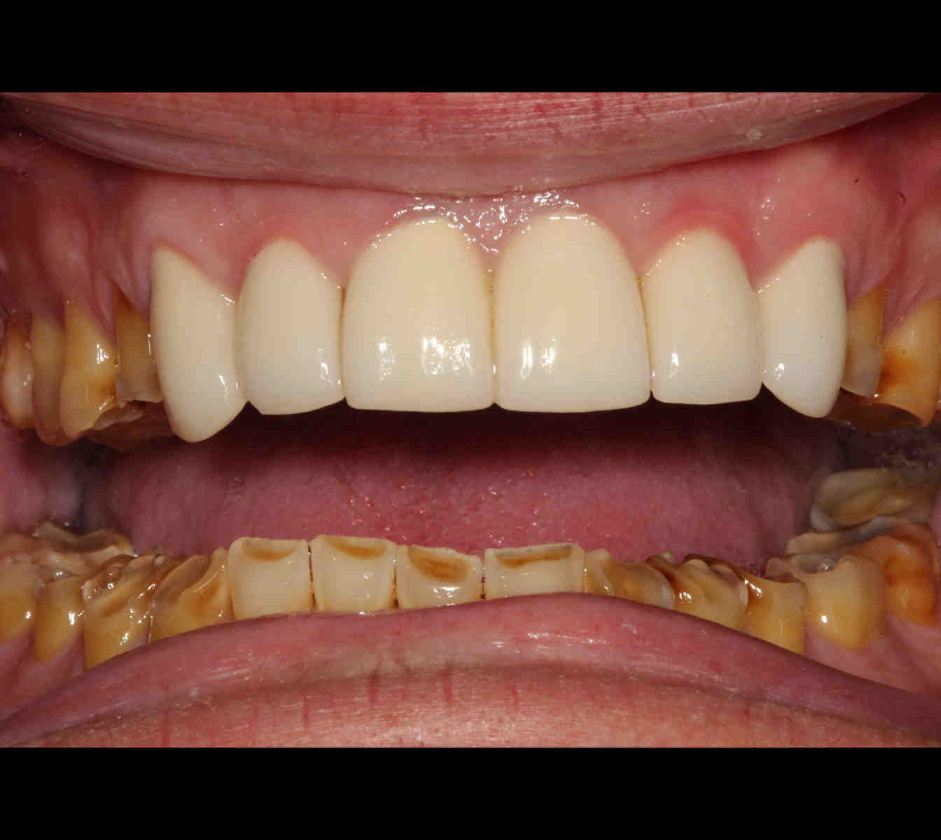 Are dental implants painful?
