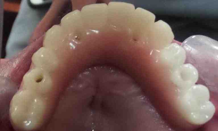 Are dental implants painful?