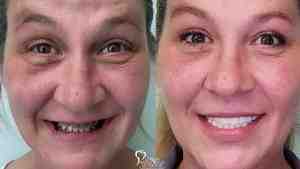 Are dental implants permanent?