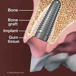 Are dental implants permanent?