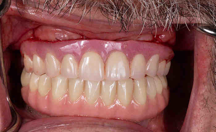 Are dental implants stronger than natural teeth reddit