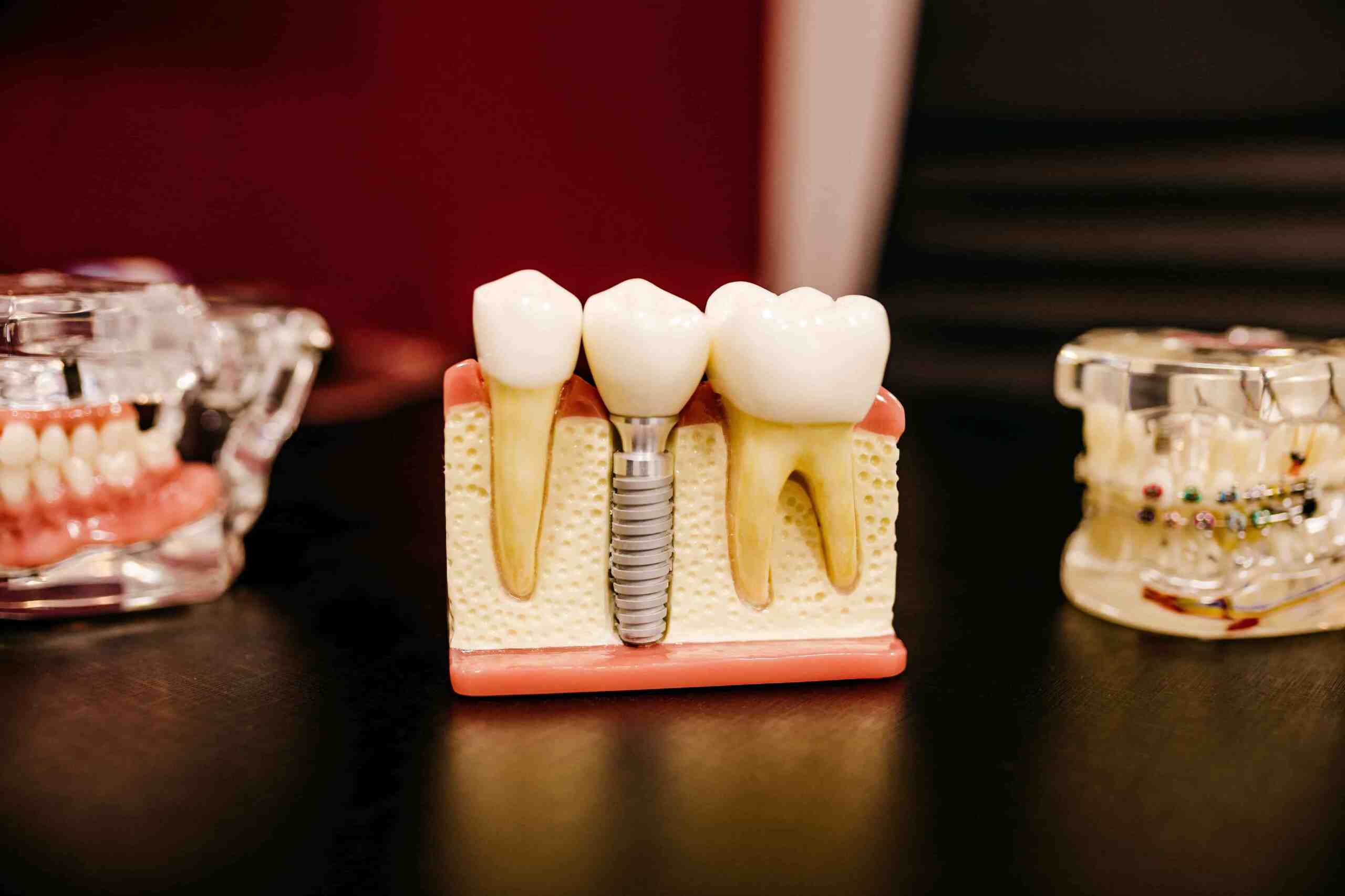 Are dental implants worth it?