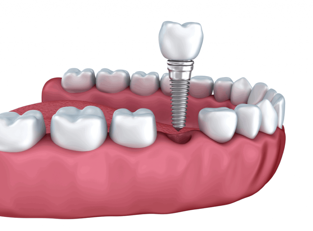 Are dental implants worth it?
