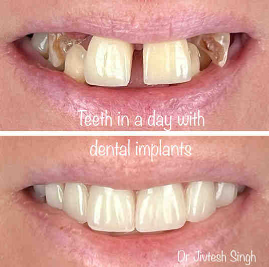 Are implant screws painful?