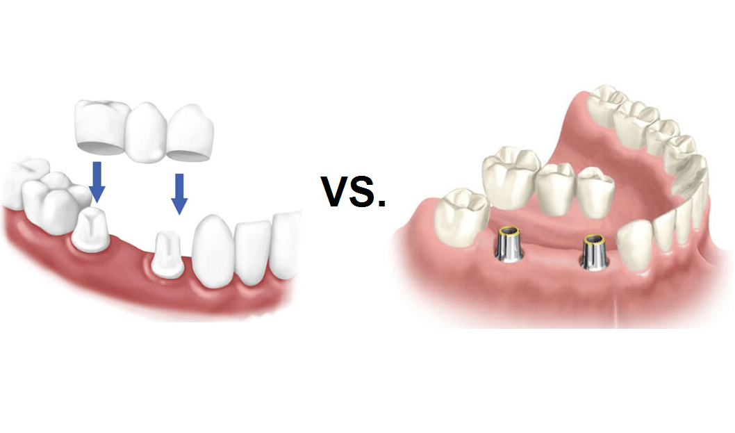 Are implants better than natural teeth?