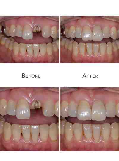 Are implants better than root canals?