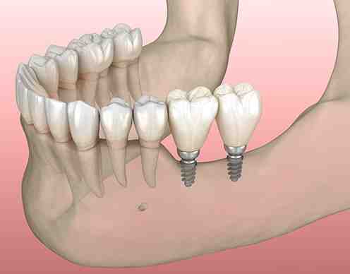 Are mini implants safe?
