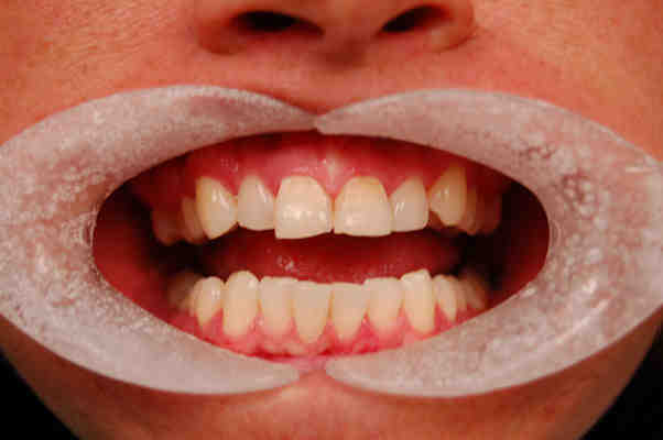 Does Sexton Dental Clinic Offer Dental Implants Dental News Network