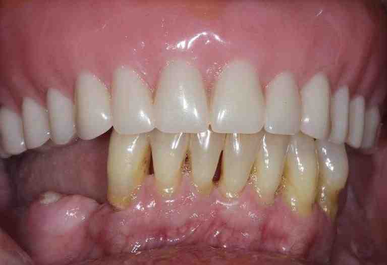 Are silicone implants banned?