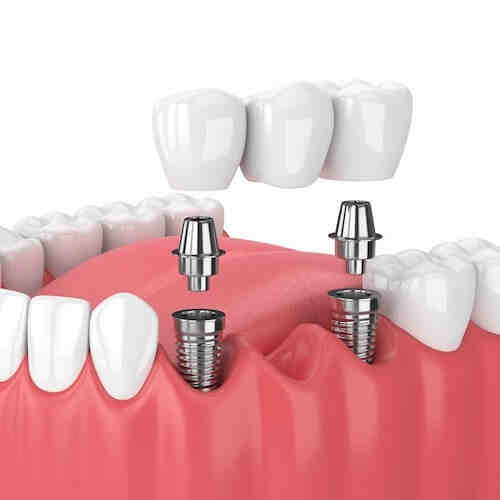 Are there any contraindications to the use of vasoconstrictors in dental patients?