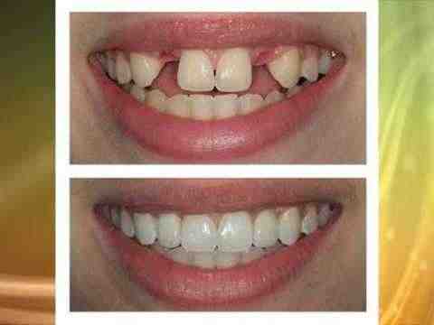 Are there different size dental implants?