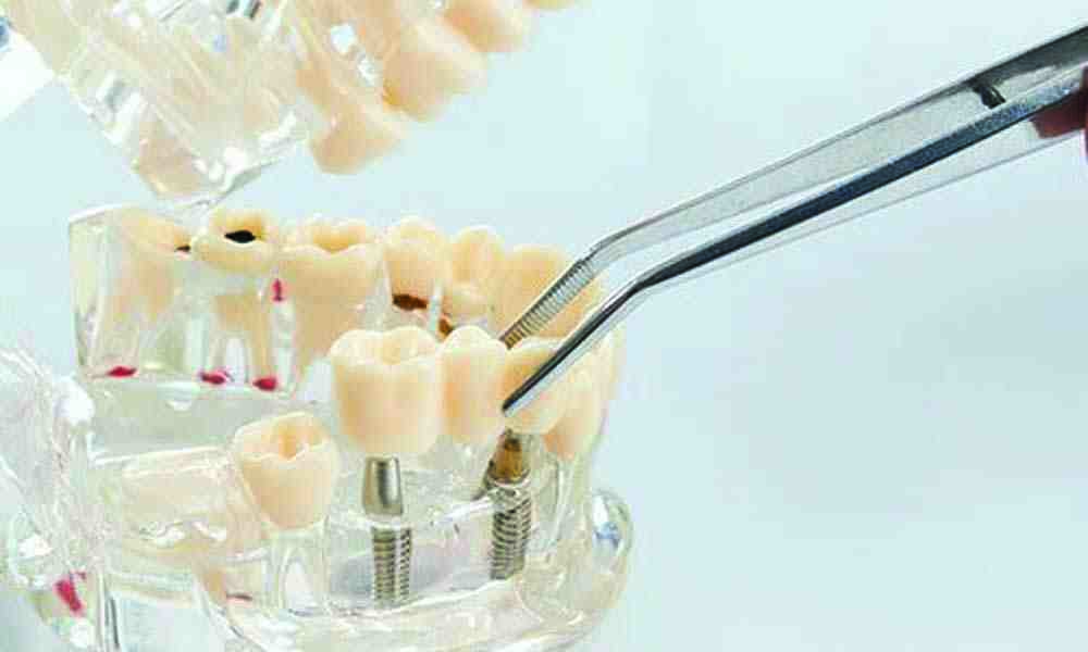 Are titanium dental implants safe?