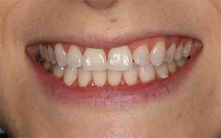 Are titanium teeth stronger?