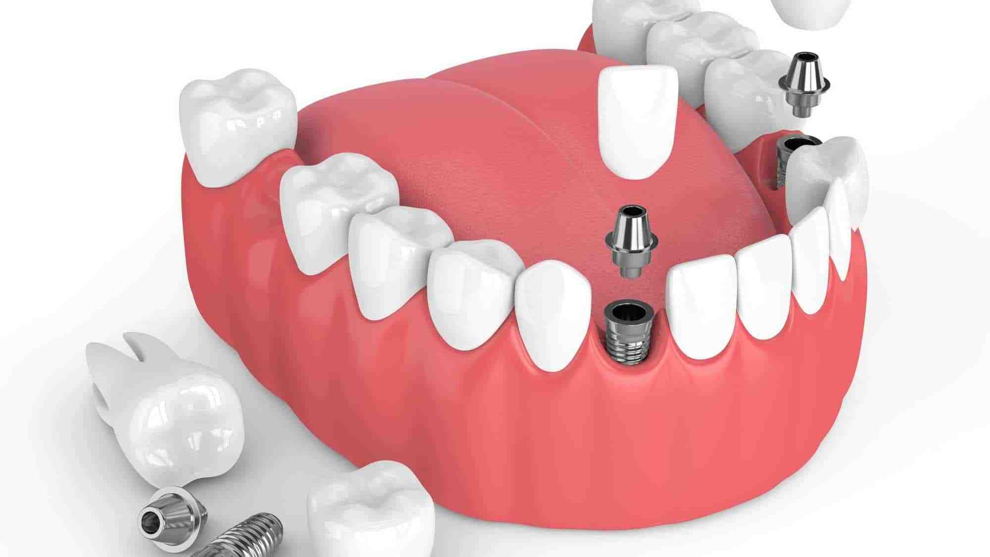 Are tooth implants painful?