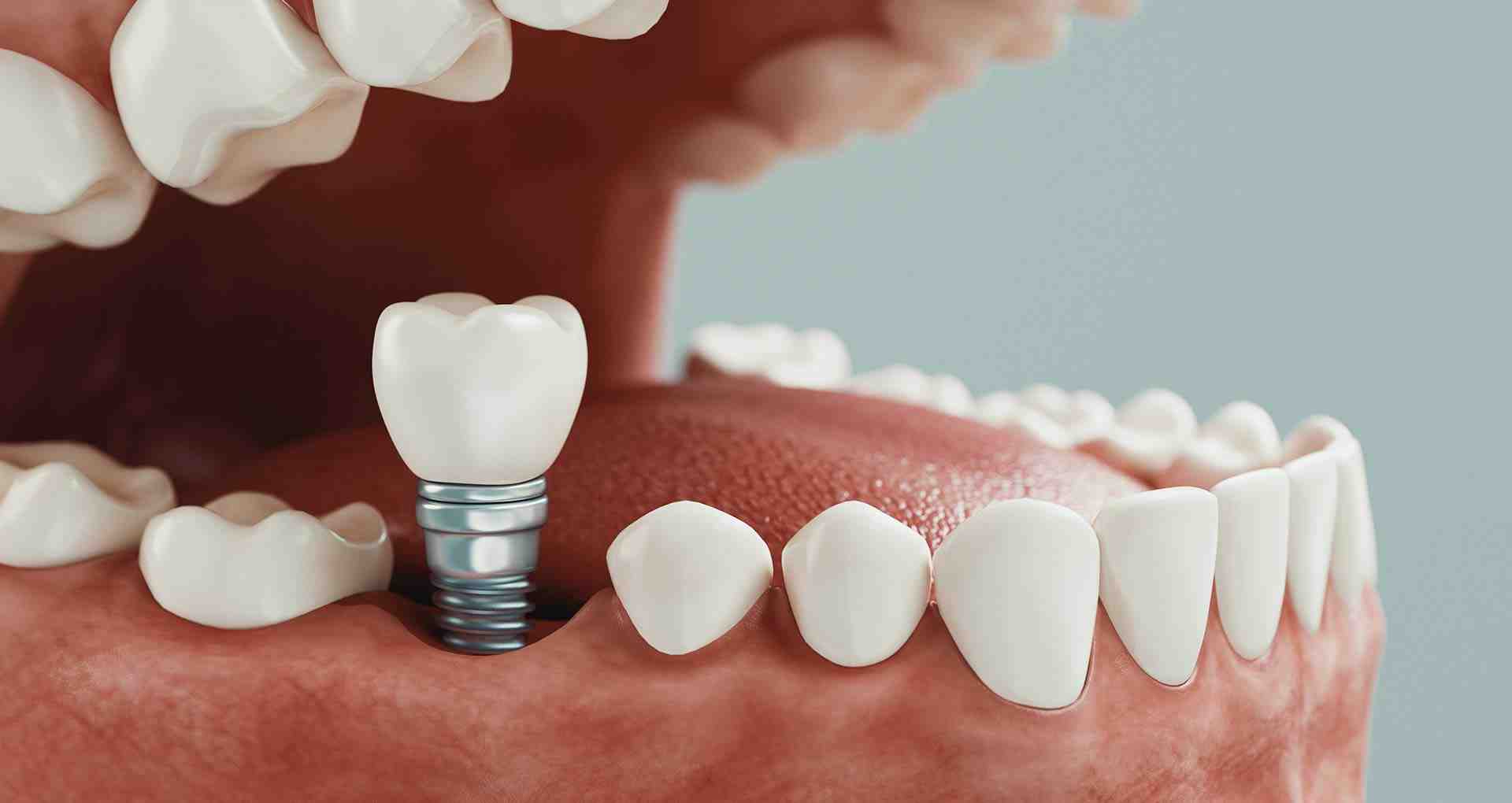 Are tooth implants worth it?