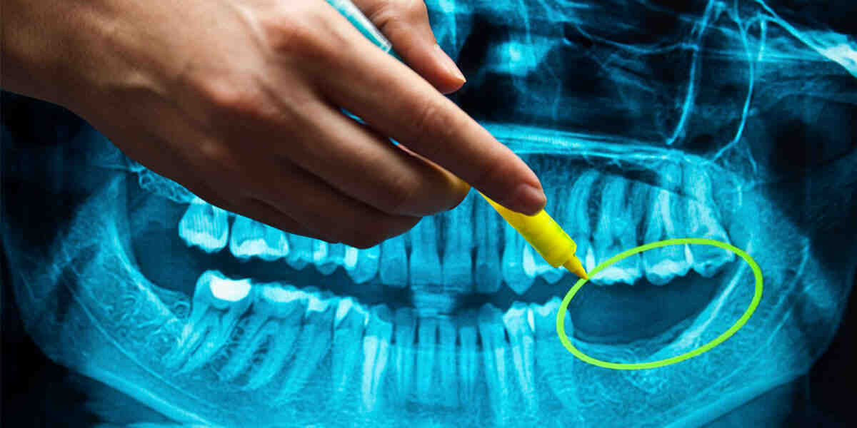 Are tooth implants worth it?