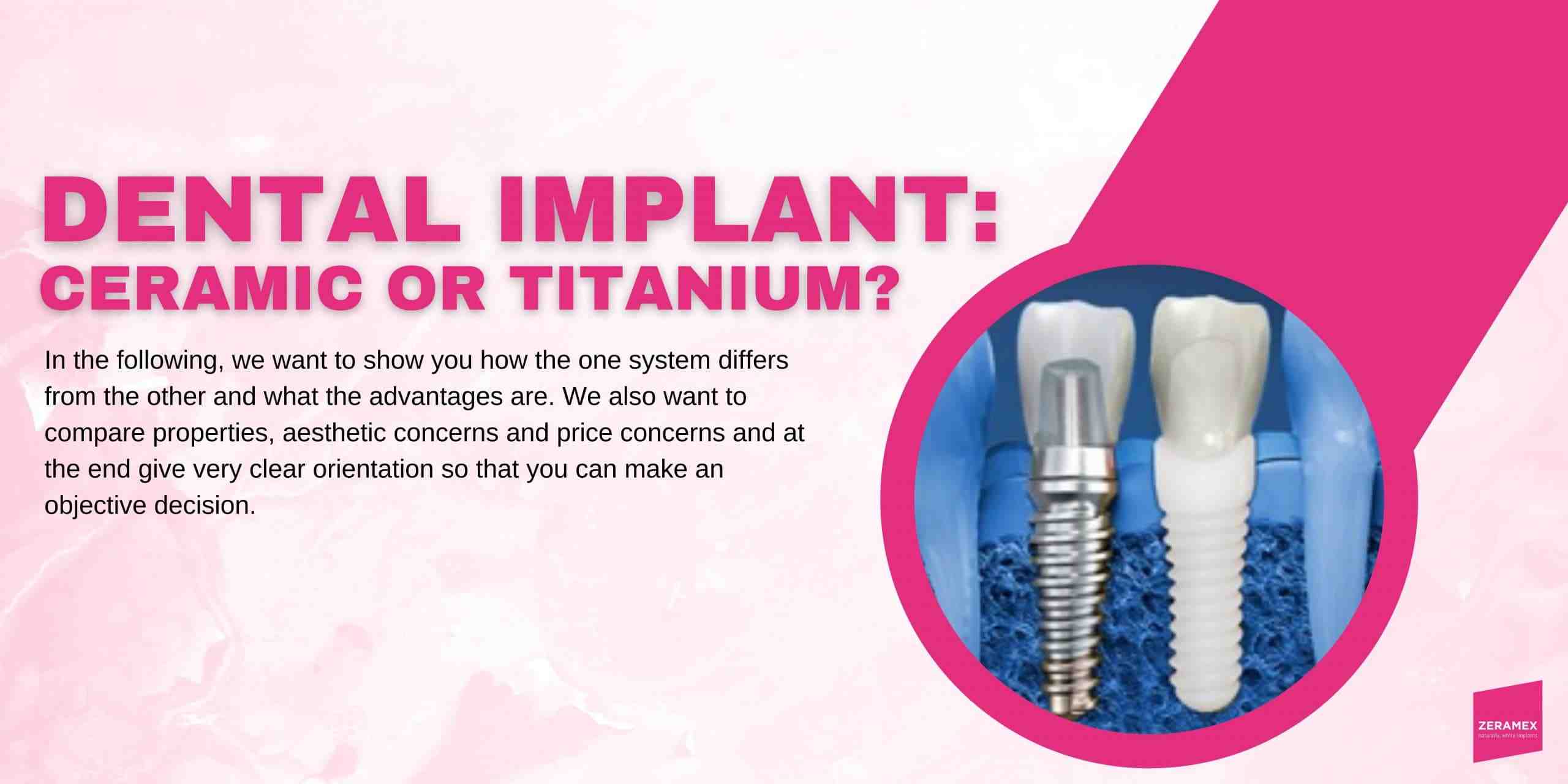 Are tooth implants worth it?
