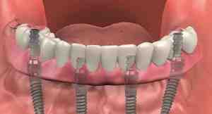 Are tooth implants worth it?