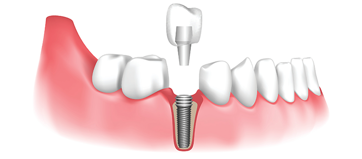 Are tooth implants worth it?
