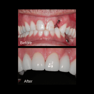 Are upper or lower implants easier?