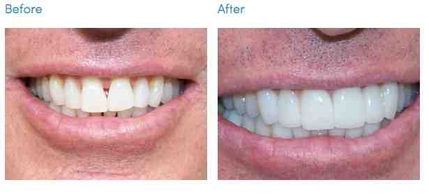 Are veneers covered by insurance?