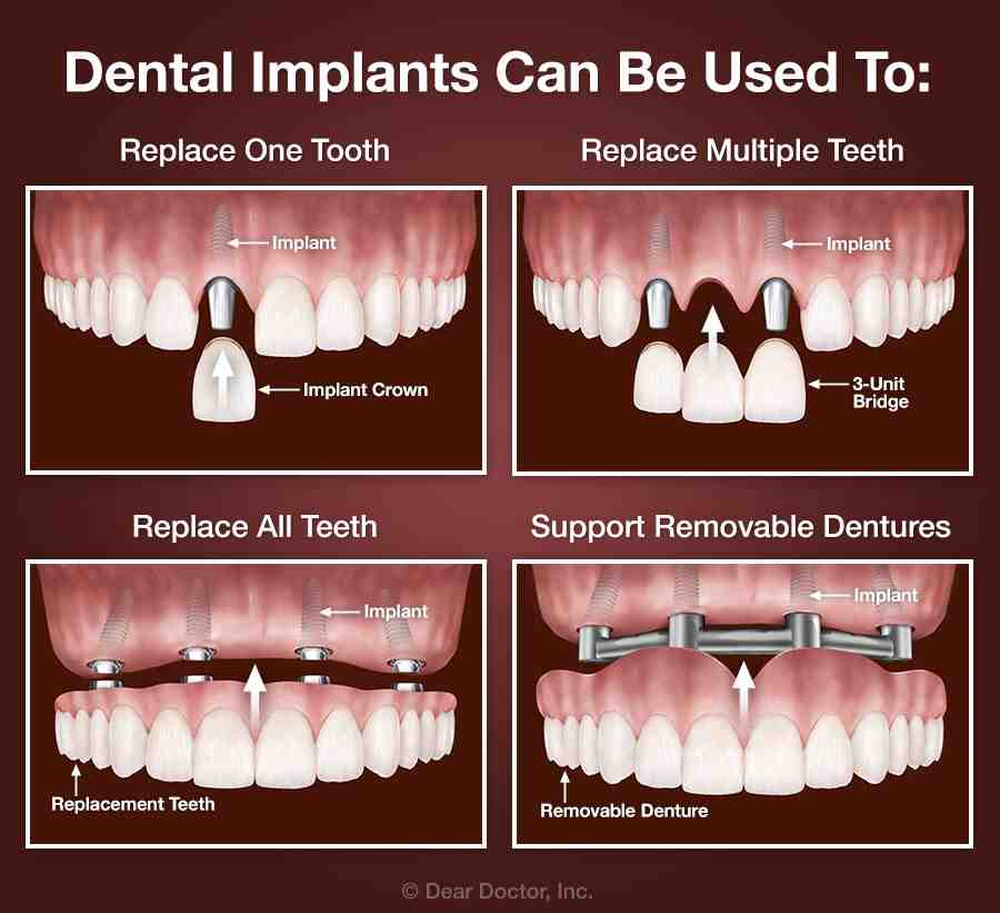 Are veneers same as implants?