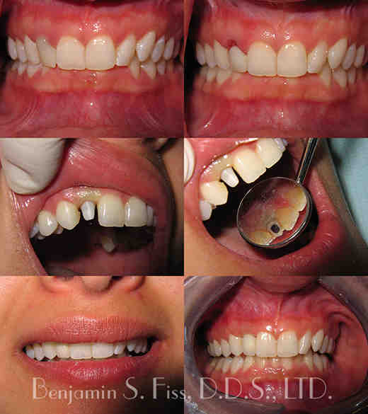 Are you put to sleep for dental implants?
