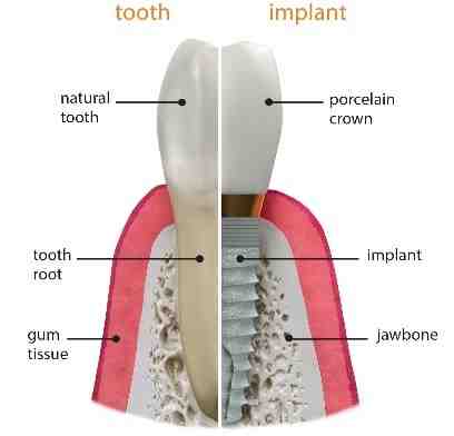 Are you put to sleep for dental implants?
