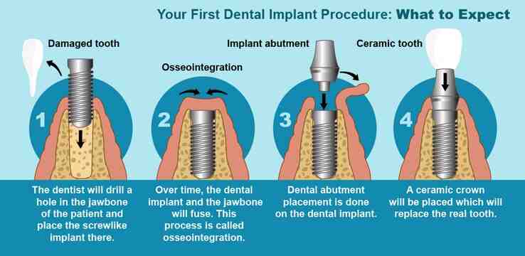 Are you put to sleep for dental implants?
