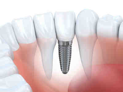 Are you put to sleep for teeth implants?