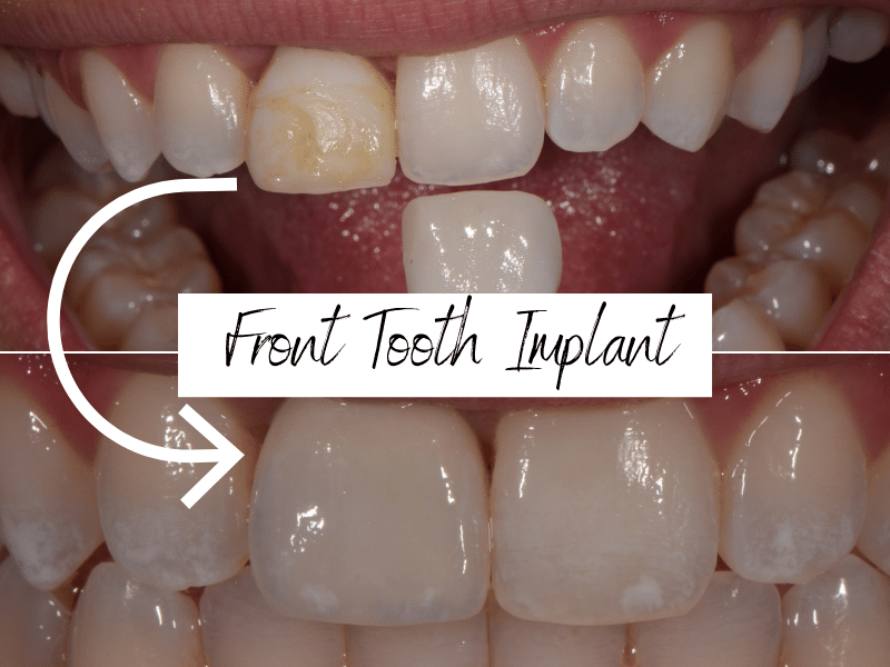 Are you put to sleep for teeth implants?