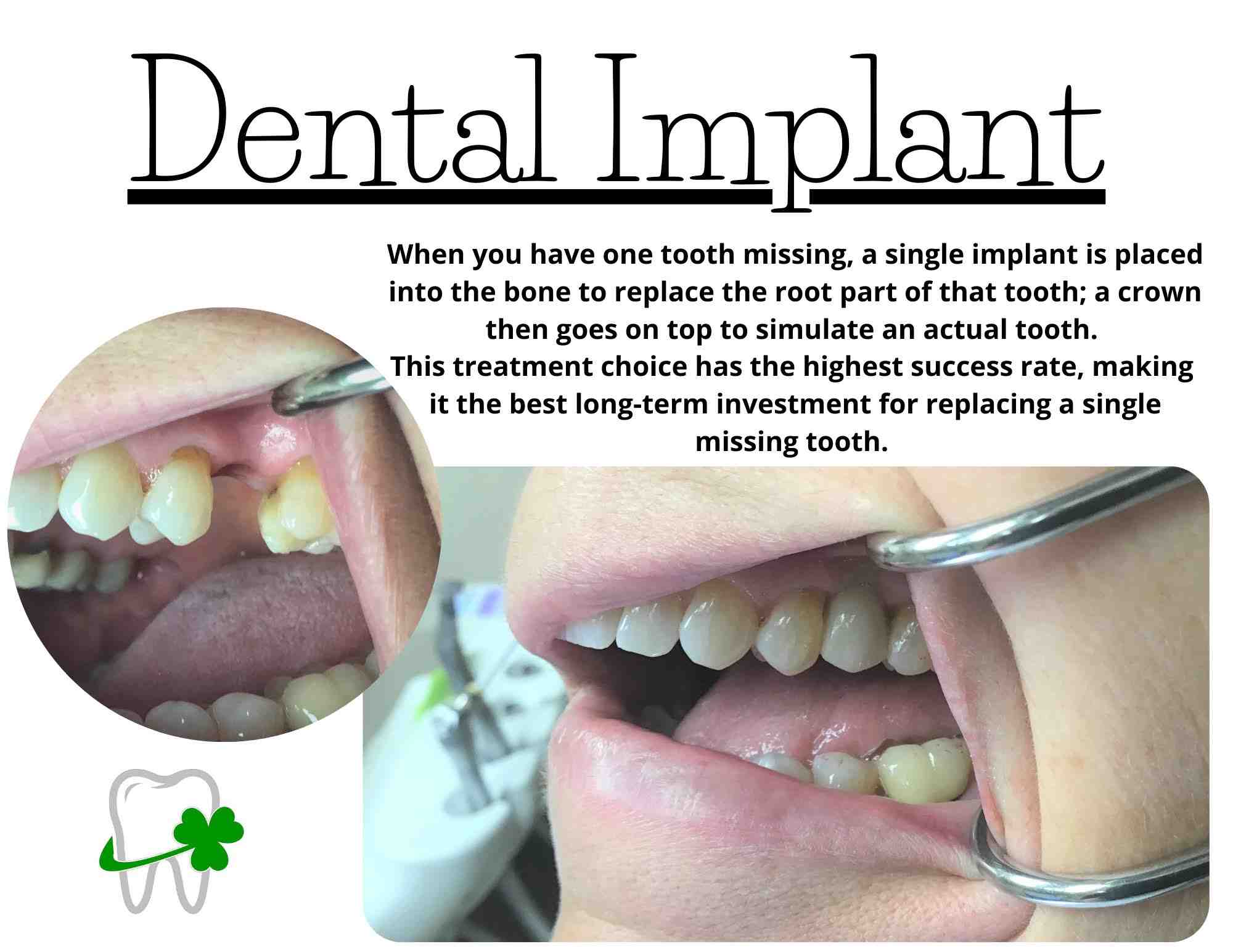Are you put to sleep for tooth implant?