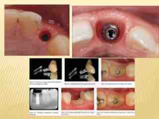 Can I brush my teeth after implant surgery?