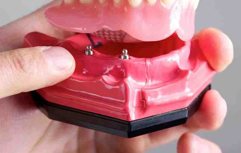 Can I chew hard food with implants?