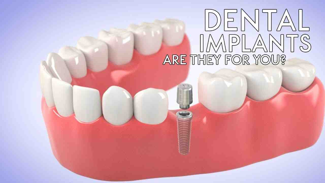 Can I drive home after dental implant?