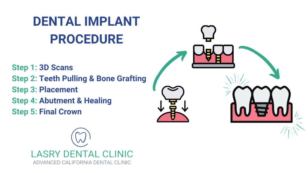 Can I drive home after dental implant?