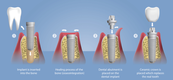 Can I eat after healing abutment?