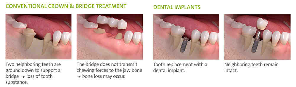 Can I eat popcorn with dental implants?