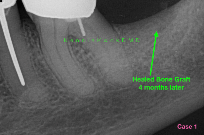 Can I get a bone graft years after tooth extraction?