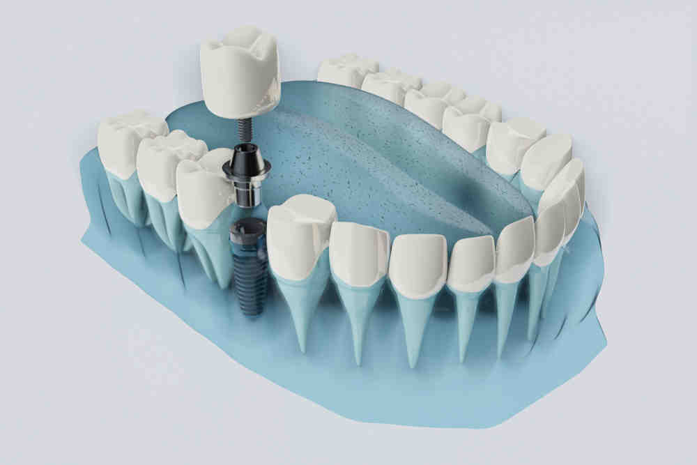 Can I get a dental implant if I have bone loss?