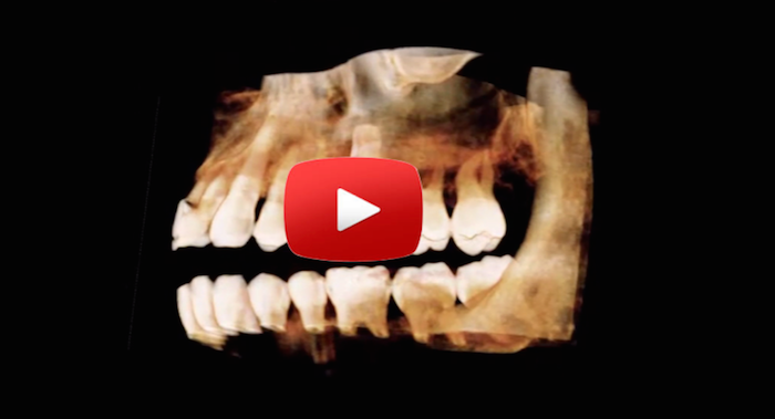 Can I get a dental implant years after extraction?