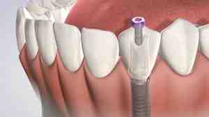 Can I get dental implant 5 years after extraction?