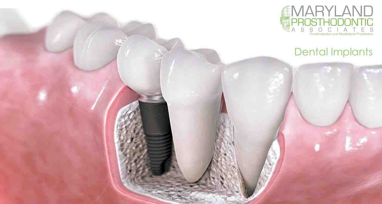 Can I have all my teeth removed and replaced with implants?