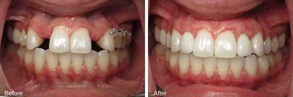 Can I have tooth implant if I have osteoporosis?