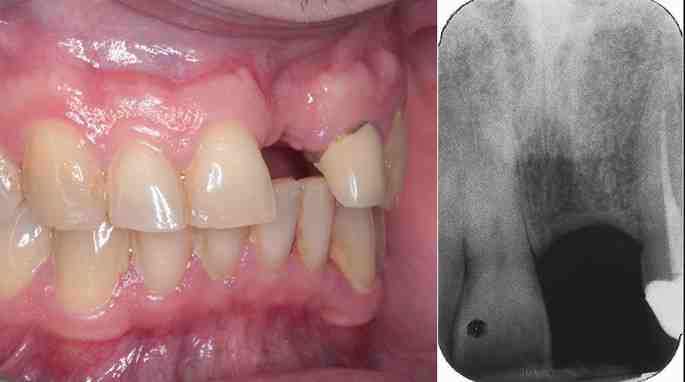 Can I use Listerine after tooth implant?