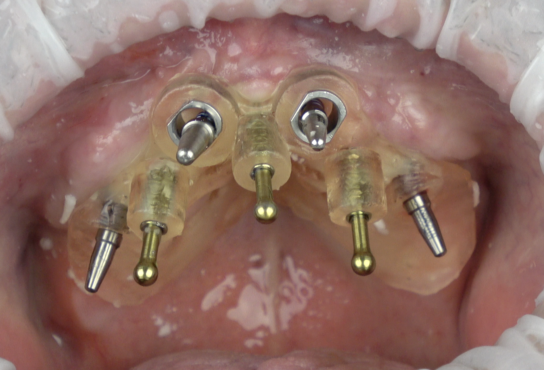Can I wait a year for an implant?