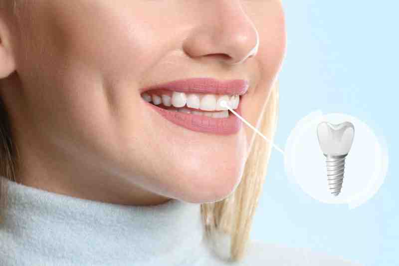 Can I work the day after dental implant?