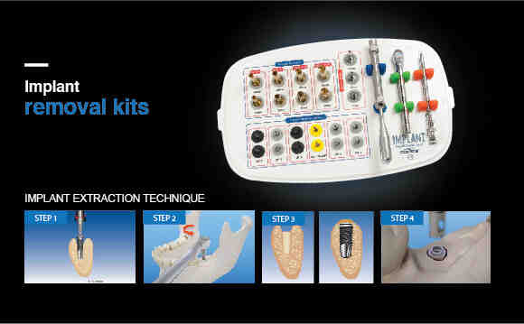 Can Type 2 diabetics have dental implants?