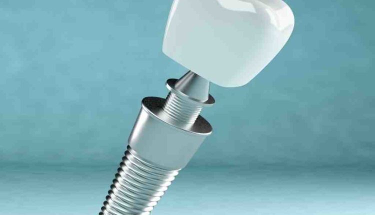 Can a broken dental implant be fixed