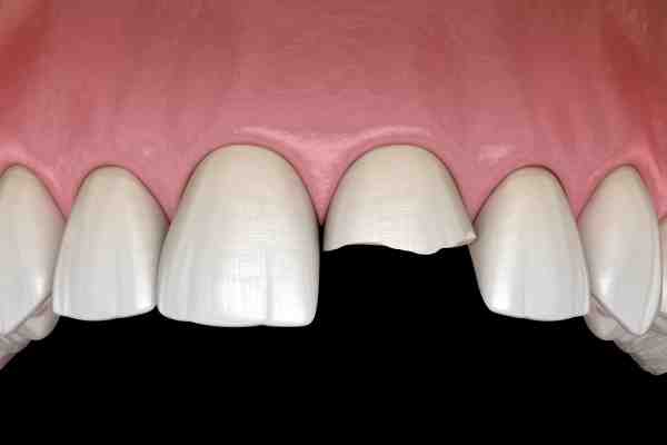 Can a crown on an implant break?
